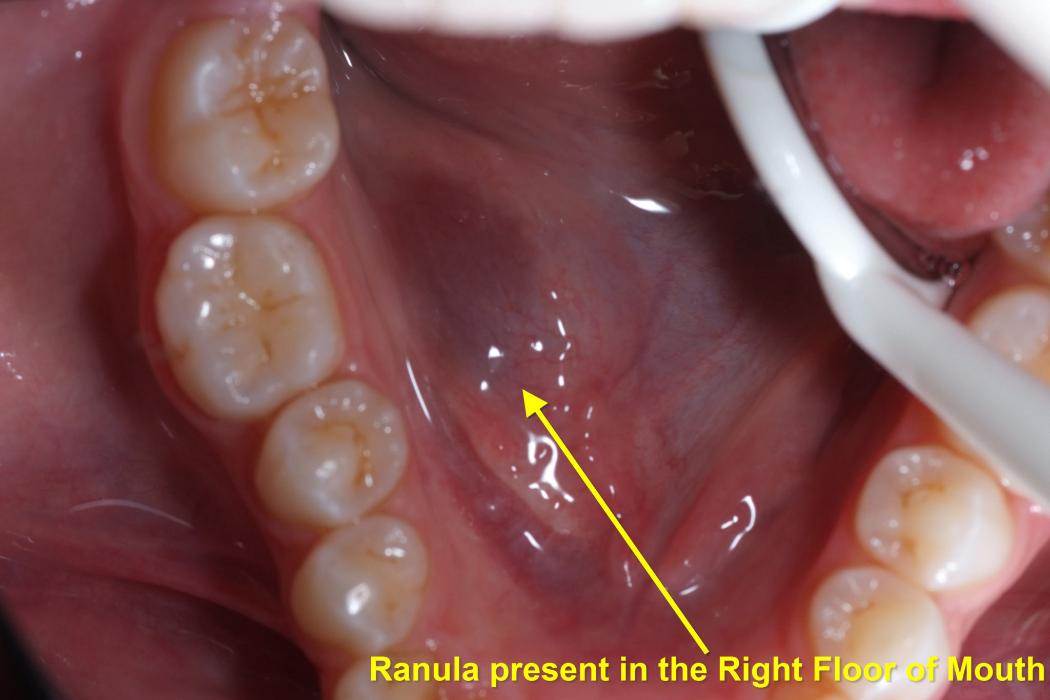 Ranulas / Ranulae & Their Treatment3